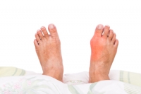 Foot Problems That Mimic Bunions