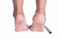 Certain Medical Conditions May Cause Cracked Heels