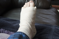 Lisfranc Fracture of the Foot