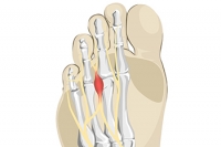 Key Facts About Morton's Neuroma