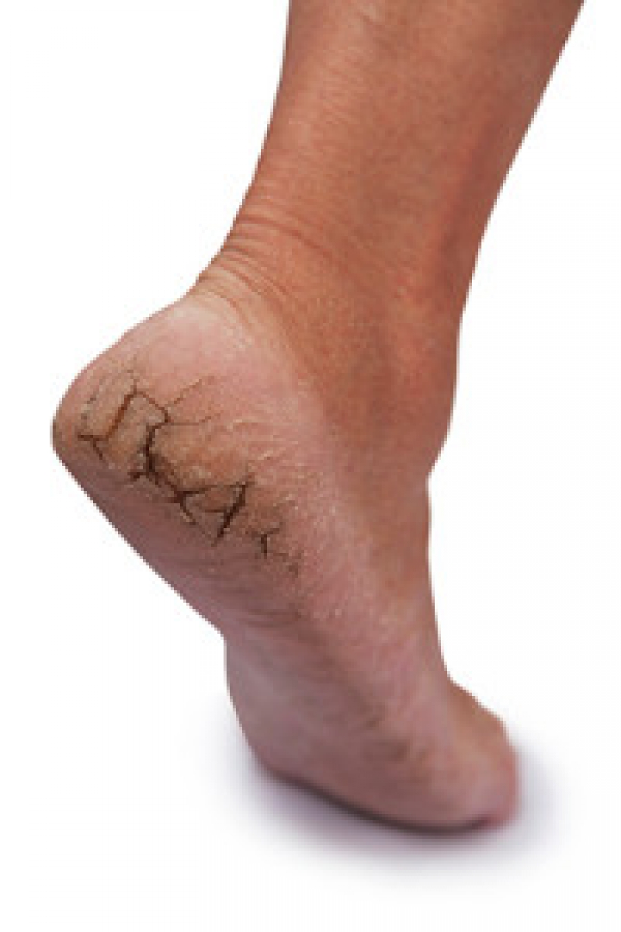 Dry Cracked Callused Heels - YouTube