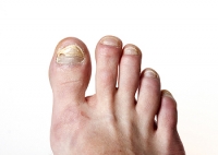 Ways to Avoid a Toenail Fungal Infection