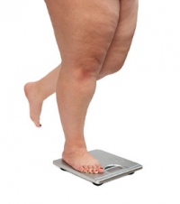 Obesity and Plantar Fasciitis